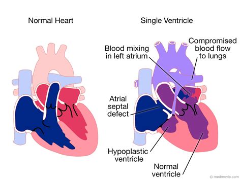 Pin By Nonas Arc On Single Ventricle Defect Congenital Heart Defect
