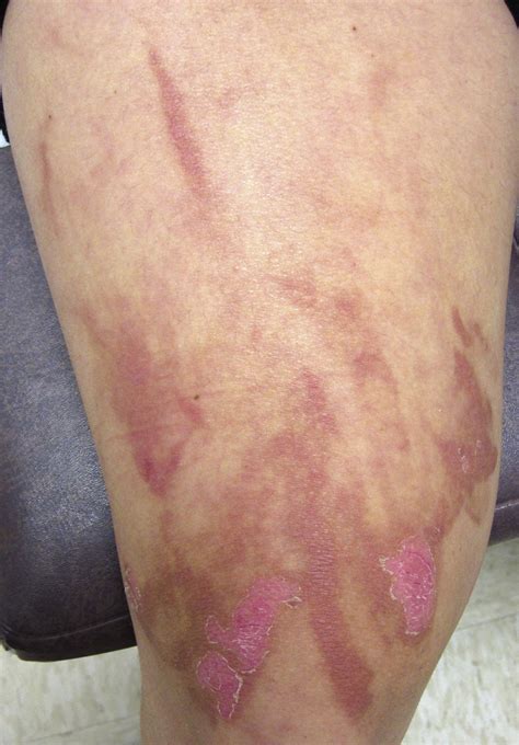 Phytophotodermatitis Journal Of Pediatric And Adolescent Gynecology