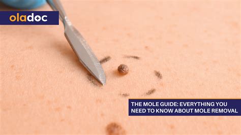 The Mole Guide Everything You Need To Know About Mole Removal Beauty
