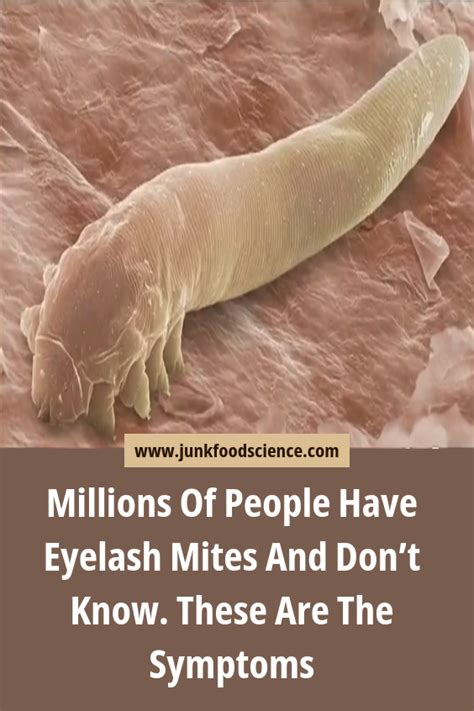 Millions Of People Have Eyelash Mites And Dont Know These Are The