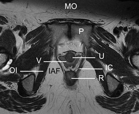 Imaging Of The Female Perineum In Adults RadioGraphics