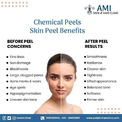 Radiant Skin With Chemical Peels