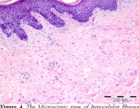 Figure 2 From Giant Fibroepithelial Polyp Of Vulva A Case Report And