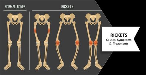 Rickets Everything You Should Know About