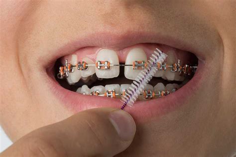 How To Look After Your Teeth After Getting Braces