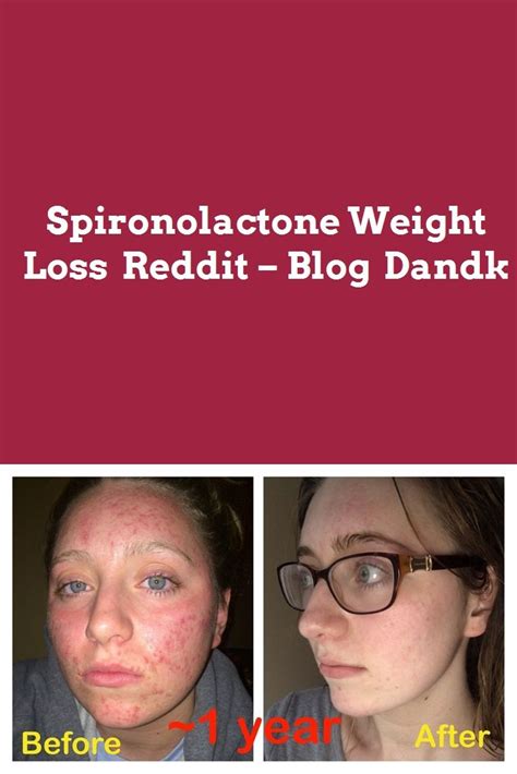 Spironolactone Weight Loss Best Solution Of Weight Loss Supplements