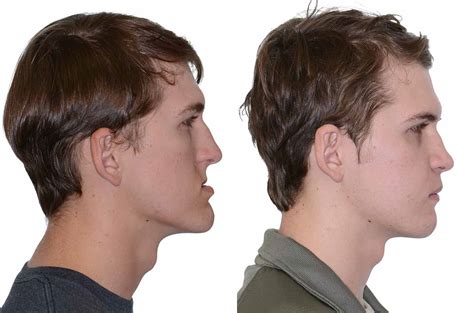Maxillary Surgery Before And After