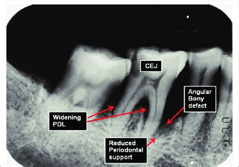 Shows That Radiographic Images Features Of Sot Included Angular Bone