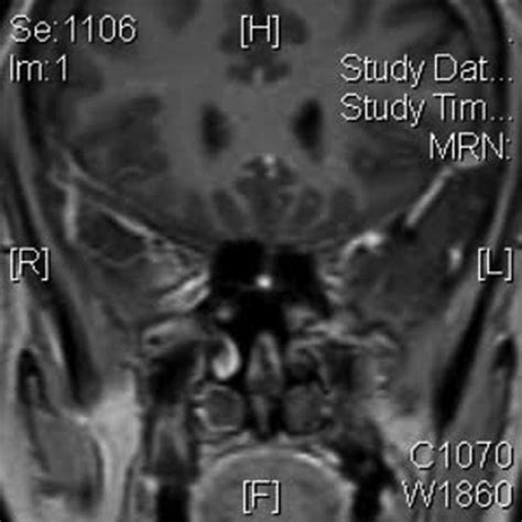 Pituitary Tuberculoma With Subsequent Drug Resistant Tuberculous