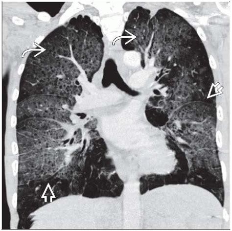 Pneumocystis Jiroveci Pneumonia Radiology Key