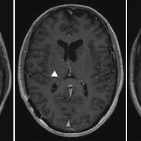 eleven month posttreatment t1 gadolinium enhanced mri brain an download scientific diagram