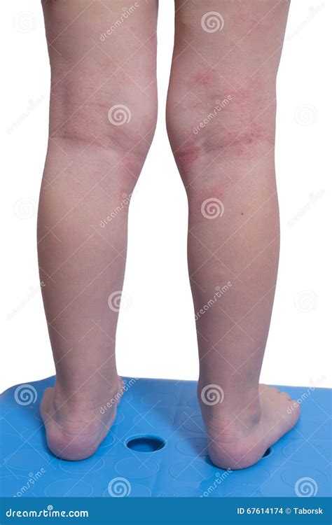 Eczema On The Kid S Legs Stock Photo Image Of Disease 67614174