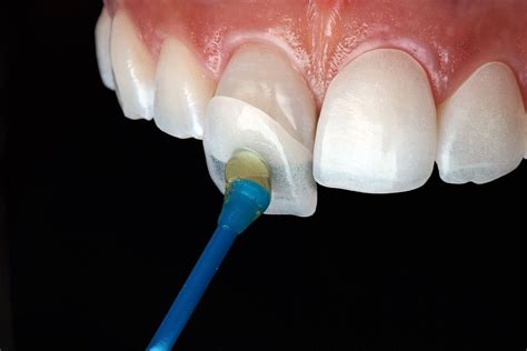 Do Dental Veneers Stain Directorio Odontológico