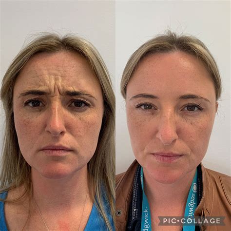 Anti Wrinkle Injections Dublin Botox Clinic Sandyford Facial Rejuve
