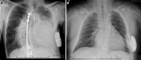 Clinical Experience With The Subcutaneous Implantable Cardioverter