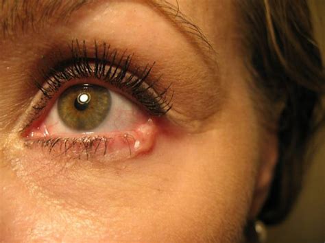 Symptoms Of Bad Eyesight Oc