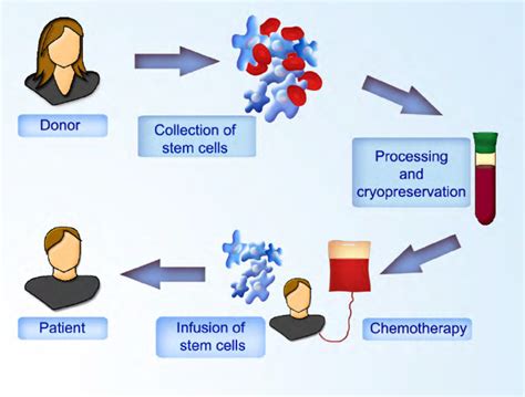 Allogeneic Stem Cell Transplantation Hematopoietic Stem Cells Are