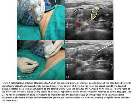 Ultrasound Guided Regional Nerve Blocks In Emergency GrepMed