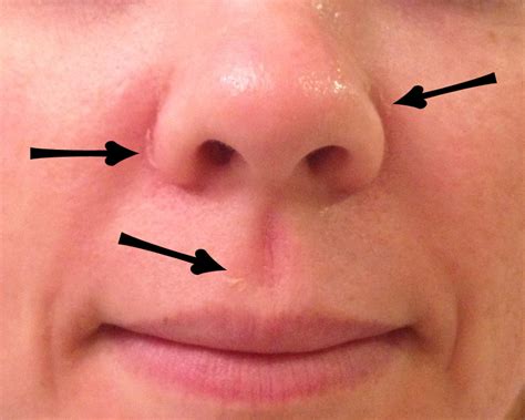 Face Rash Around Mouth Pictures Photos