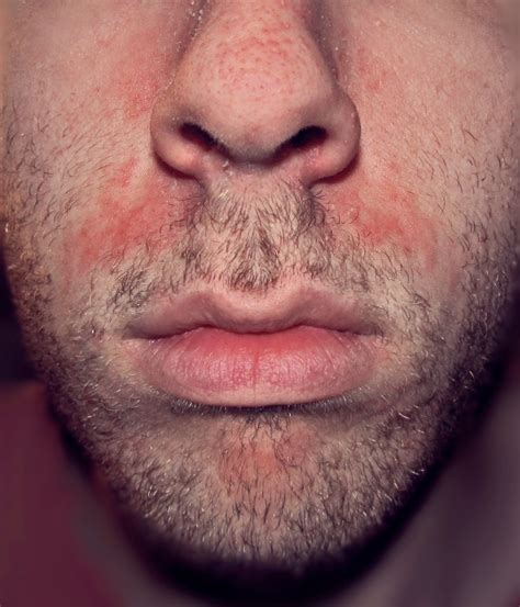 Skin Disease Types Seborrheic Dermatitis