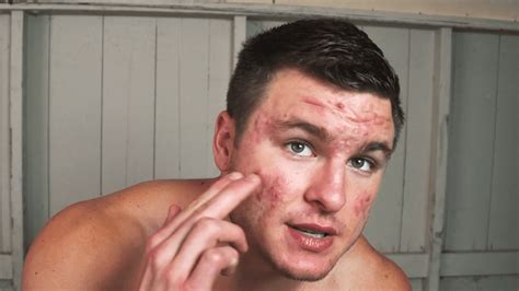 Bodybuilder With Acne Covering His Whole Face Transformed His Skin By