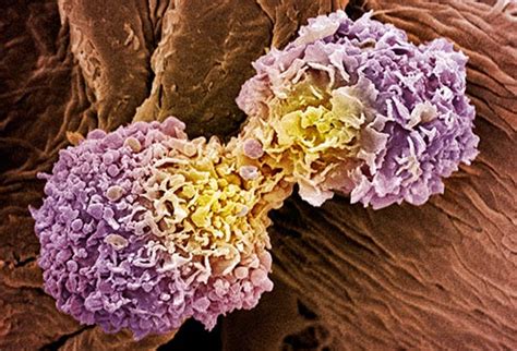 While breast cancer can metastasize to any bone in the body, it most commonly spreads to the spine, pelvis, ribs, and long bones of the arms and legs (humerus and femur). Slideshow: Where Breast Cancer Spreads: Lymph Nodes, Bones ...