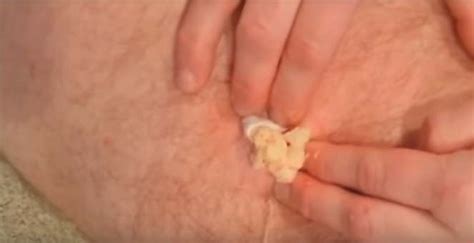 Big Cyst Explosion New Pimple Popping Videos