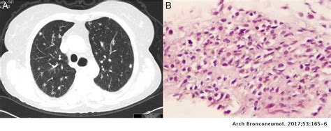 Systemic Sclerosis And Kaposis Sarcoma With Pulmonary Involvement An