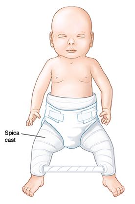 Developmental Dysplasia of the Hip in Children
