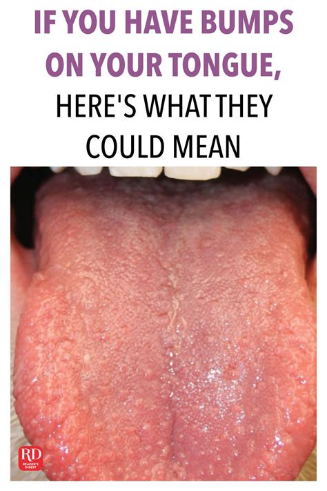 White Spots On Tongue White Spots On Tongue Bumps Pat