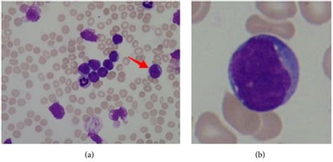 Acute Leukemia Blood Smear