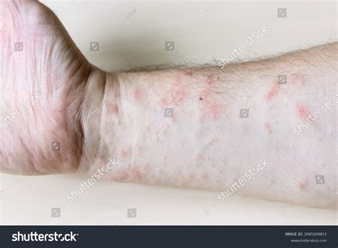 Sample Allergic Contact Dermatitis Pink Rash Stock Photo 2065209812