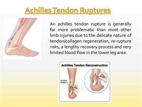 Calaméo Treatment Of Achilles Tendon Ruptures