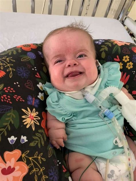 Baby With Rare Dwarfism Is Home After 184 Days In Hospital Abc News
