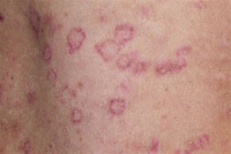 Influenza viruses and vaccines have triggered pityriasis rosea in some cases. How common is pityriasis rosea? | Chemist+Druggist