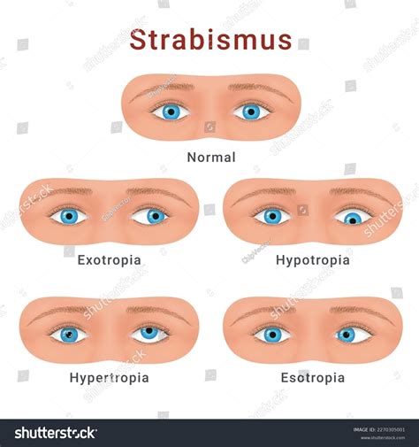 Vektor Stok Strabismus Eyes Types Normal Hypotropia Hypertropia Tanpa
