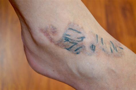 Do you get scars after laser tattoo removal? Skinial Treatments Leave Scars - Disappear Ink Tattoo ...