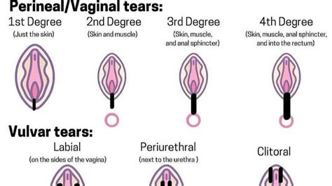 Perineal Tear Yahoo Image Search Results Perineal Tear Vaginal Tears