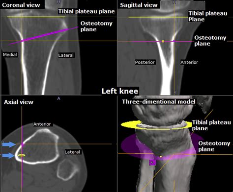 Opening Wedge High Tibial Osteotomy Using Combined Computed Tomography