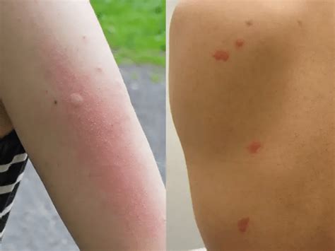 Do Bed Bug Bites Itch 7 Ways To Relieve Bed Bug Itch 2021 Guide