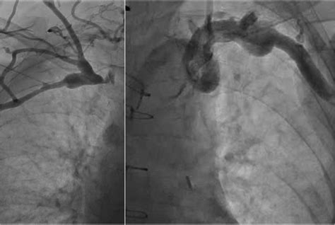 Coronary Artery Bypass Grafting With Internal Thoracic Arteries May