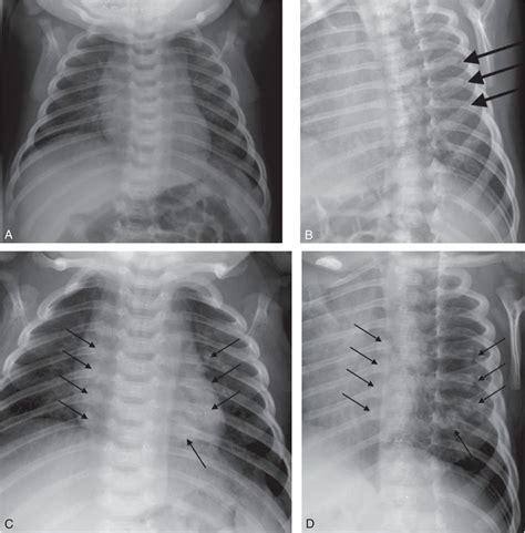 Bony Thoracic Trauma Radiology Key