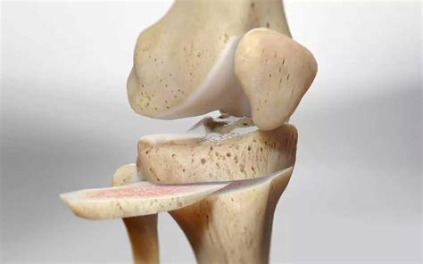 High Tibial Osteotomy And Leg Corrective Deformities Dr Issam Mardini
