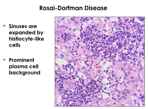 Rosai Dorfman Disease Multiple Painless Lymphadenopathy Matted Lymph
