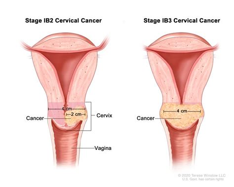 Cervical Cancer Treatment PDQ Patient Version Siteman Cancer Center
