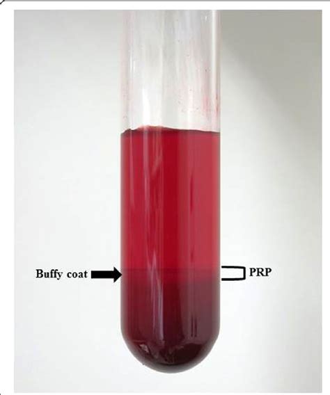 Whole Blood In A Tube Containing Acd Which Was Anticoagulant After