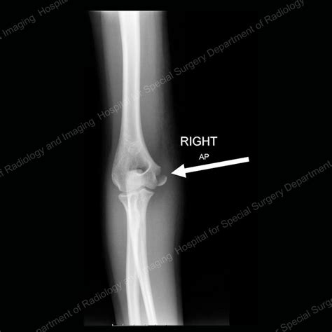 X Ray Broken Elbow