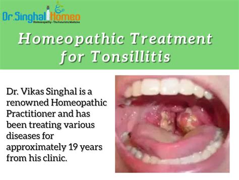 Homeopathic Treatment For Tonsillitis By Dr Singhal Homeo On Dribbble