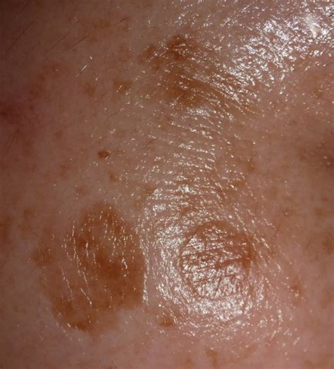 Age Spots Symptoms Causes Treatment Pictures Prevention Health Md