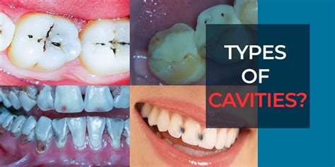 Different Types Of Cavities In Teeth Teeth Poster
